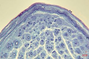 n. suralis - hypertrophic demyelinizing neuropathytoluidine-blue-stained semithin section